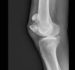 Fracture de la rotule – Orthopole du Renaison